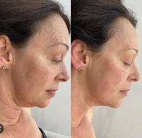 Thumbnail for Anti - Aging HIFU, EMS and Microcurrent 2.0, Wrinkle Remover - Epic Trends and Gifts - Massager - Anti - Aging HIFU, EMS and Microcurrent 2.0, Skin Tightening, Anti - Aging, Lifting, Firming, Toning, Wrinkle Remover - Epic Trends and Gifts - Massager - Anti - Aging HIFU, EMS and Microcurrent 2.0, Skin Tightening, Anti - Aging, Lifting, Firming, Toning, Wrinkle Remover