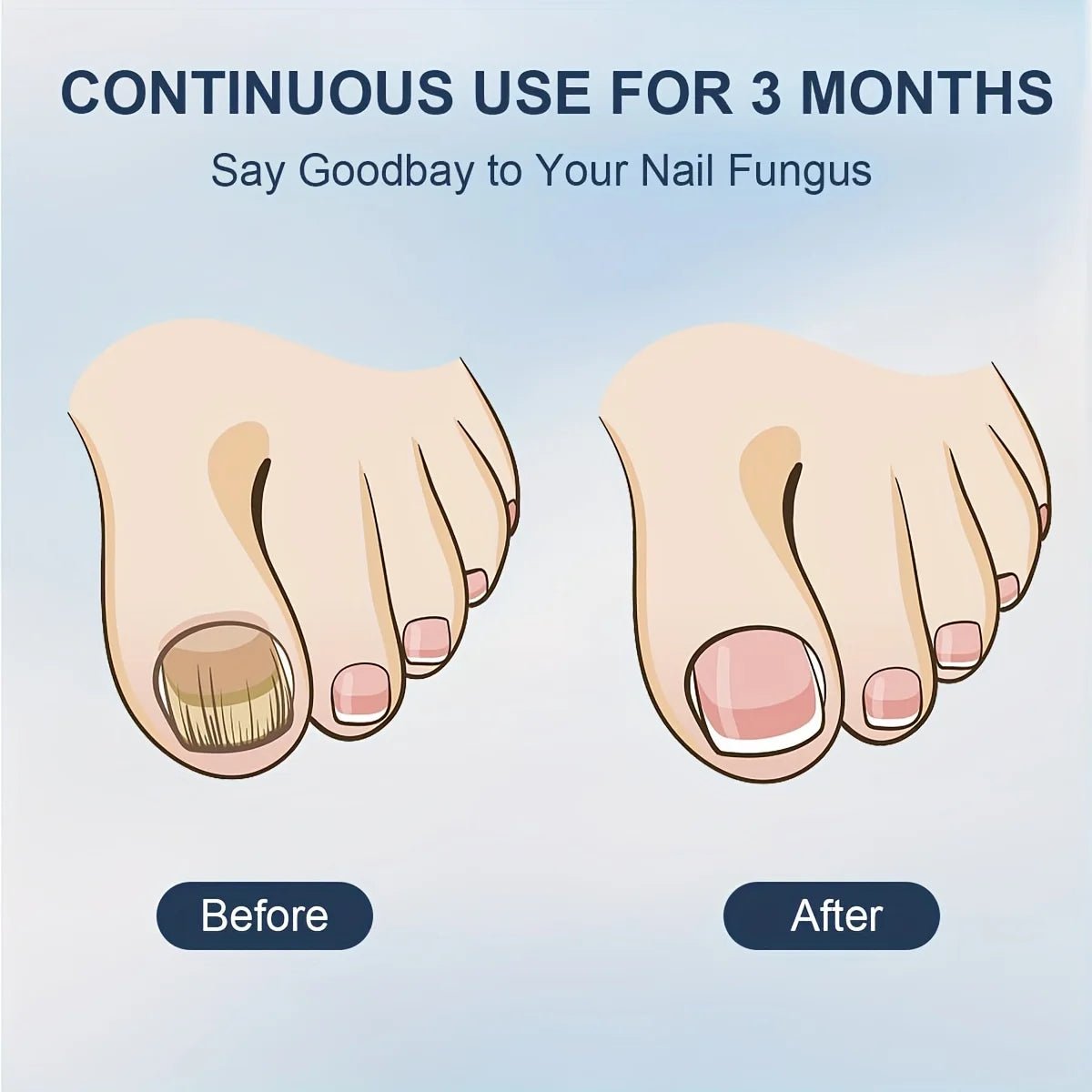 Effective Nail Fungus Laser Treatment - Blue Therapy Device - Epic Trends and Gifts - Nail Care Tools - S765d7676ccc042408654a3242515edb9c
