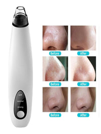 Thumbnail for Electric Blackhead Remover with Diamond Suction for Pore Cleansing - Epic Trends and Gifts - Skin Care Tools - Professional Product Title: 