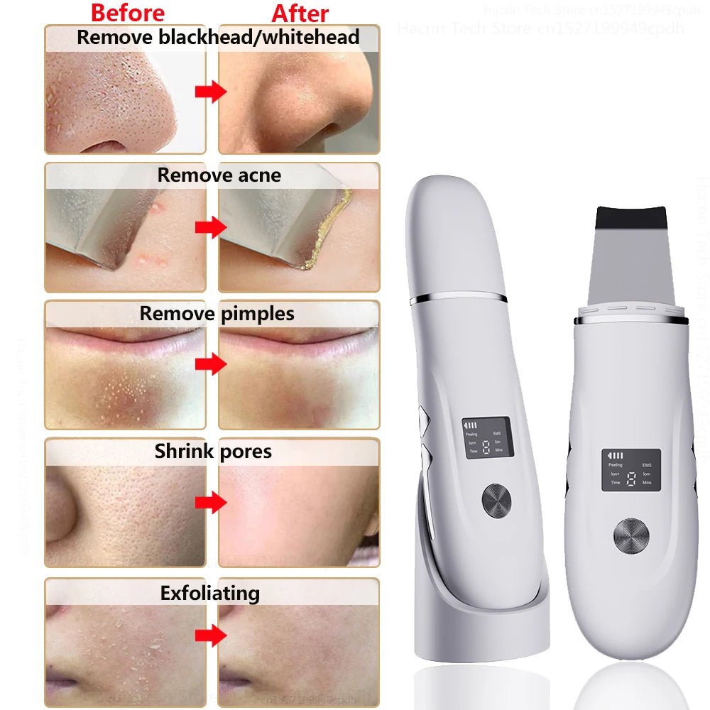 Ultrasonic Blackhead Remover & Facial Skin Scrubber - Skin Lifting and Pore Cleaning - Epic Trends and Gifts - Skincare - S55acb9b8cd0f461f96e527bf368928795