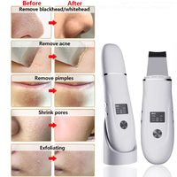 Thumbnail for Ultrasonic Blackhead Remover & Facial Skin Scrubber - Skin Lifting and Pore Cleaning - Epic Trends and Gifts - Skincare - S55acb9b8cd0f461f96e527bf368928795